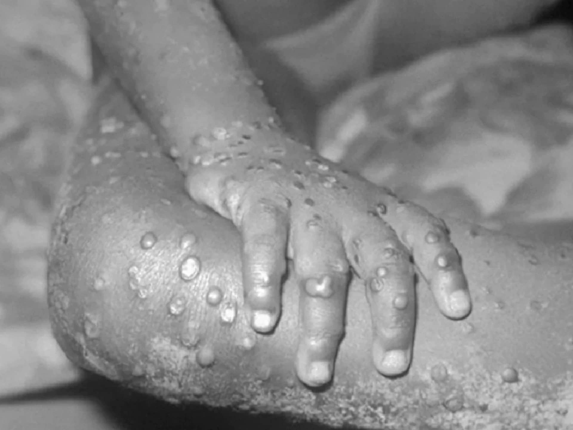 No border closure yet amid increasing monkeypox cases abroad