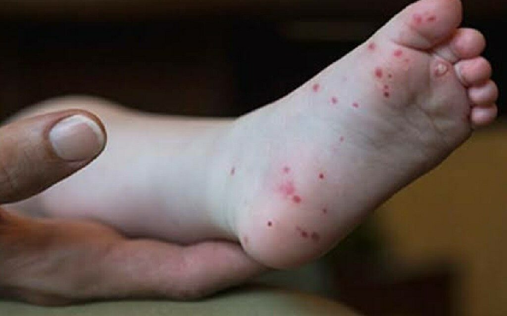 Hand-foot-and-mouth disease cases soar in Iloilo