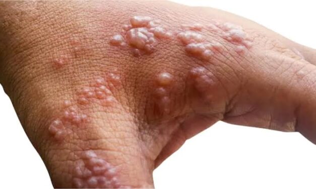 DOH on top of situation, Palace says after monkeypox detection