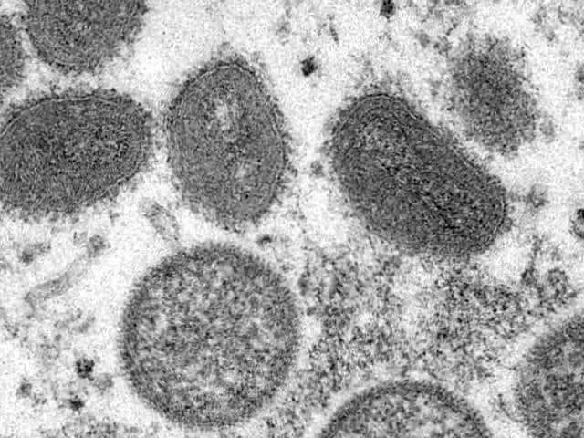 No need for lockdowns to prevent spread of monkeypox