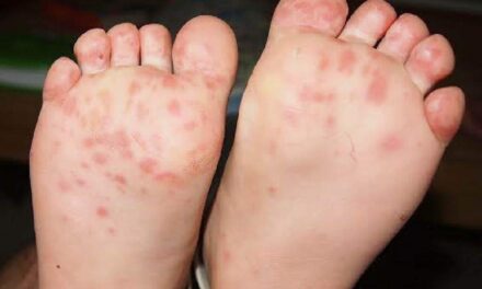 24 Iloilo towns record HFMD cases