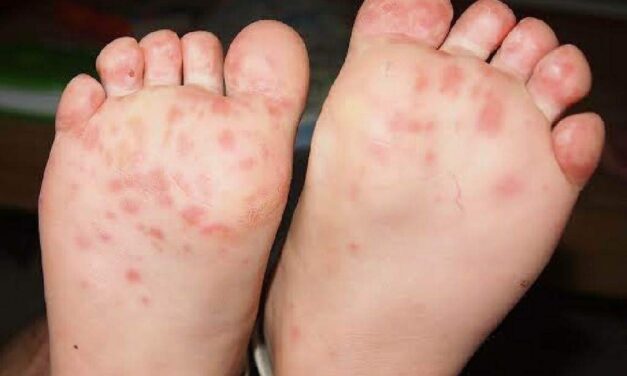 24 Iloilo towns record HFMD cases