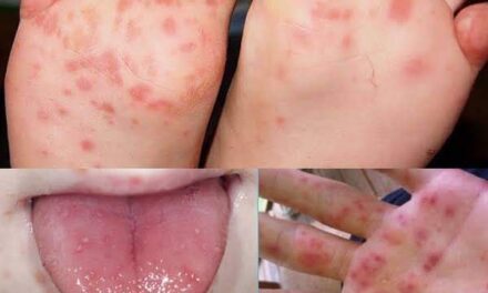 Iloilo province faces HFMD outbreak