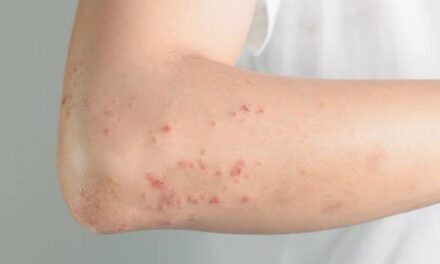 Measles outbreak recorded in Iloilo City