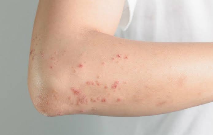 Measles outbreak recorded in Iloilo City